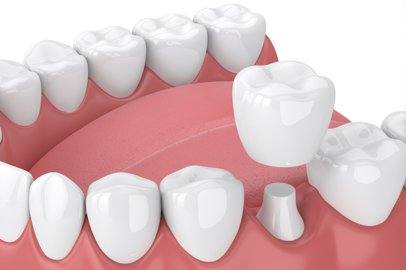 Dental Crowns in Thorndale