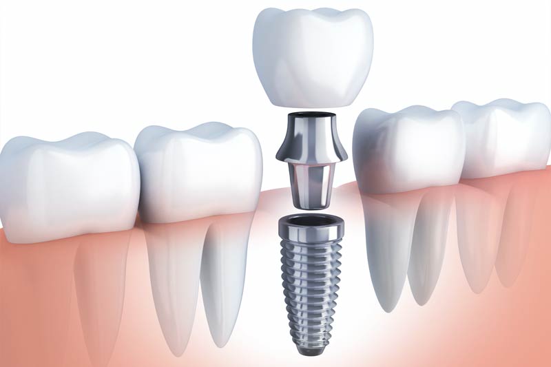 Implants Dentist in Thorndale