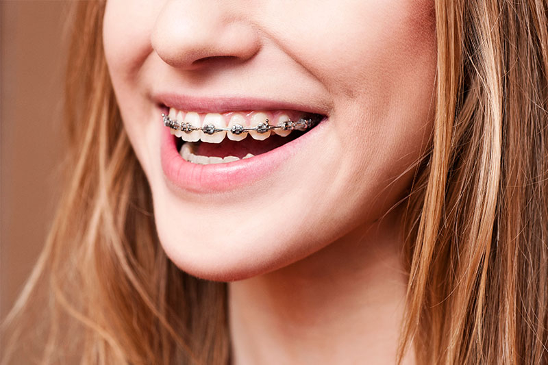 Orthodontics in Thorndale