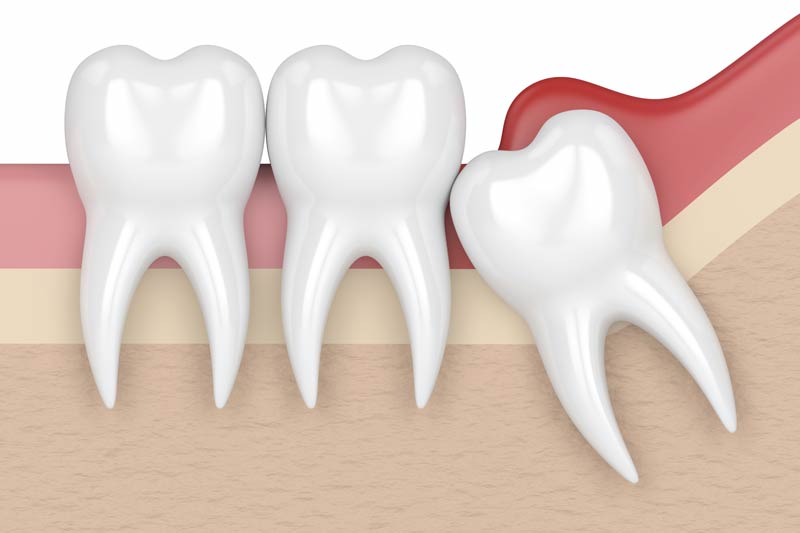 Wisdom Tooth Removal in Thorndale